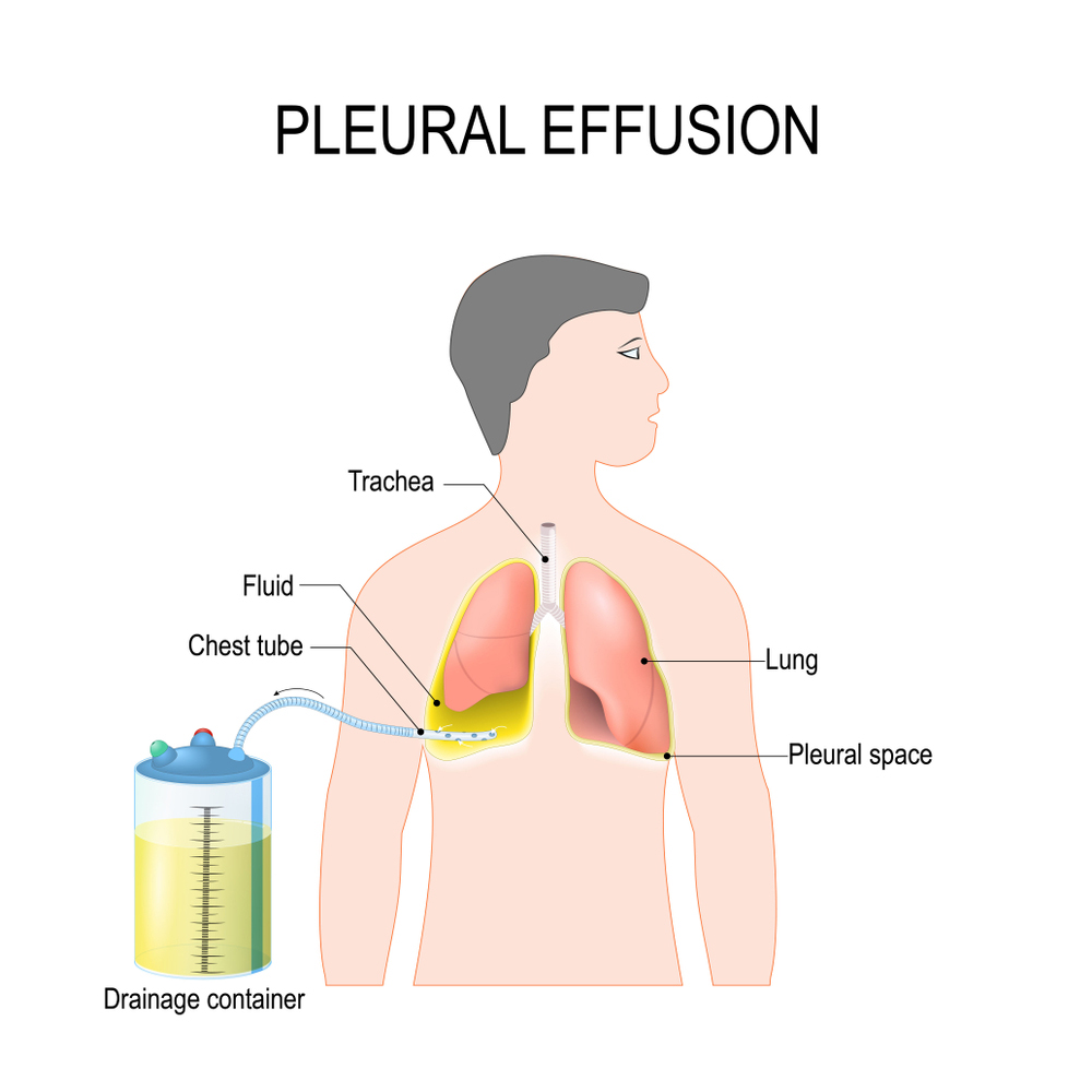 Pig Tail Catheter for deteching Pleural effusion in Mumbai by Dr. Dhiraj Jain